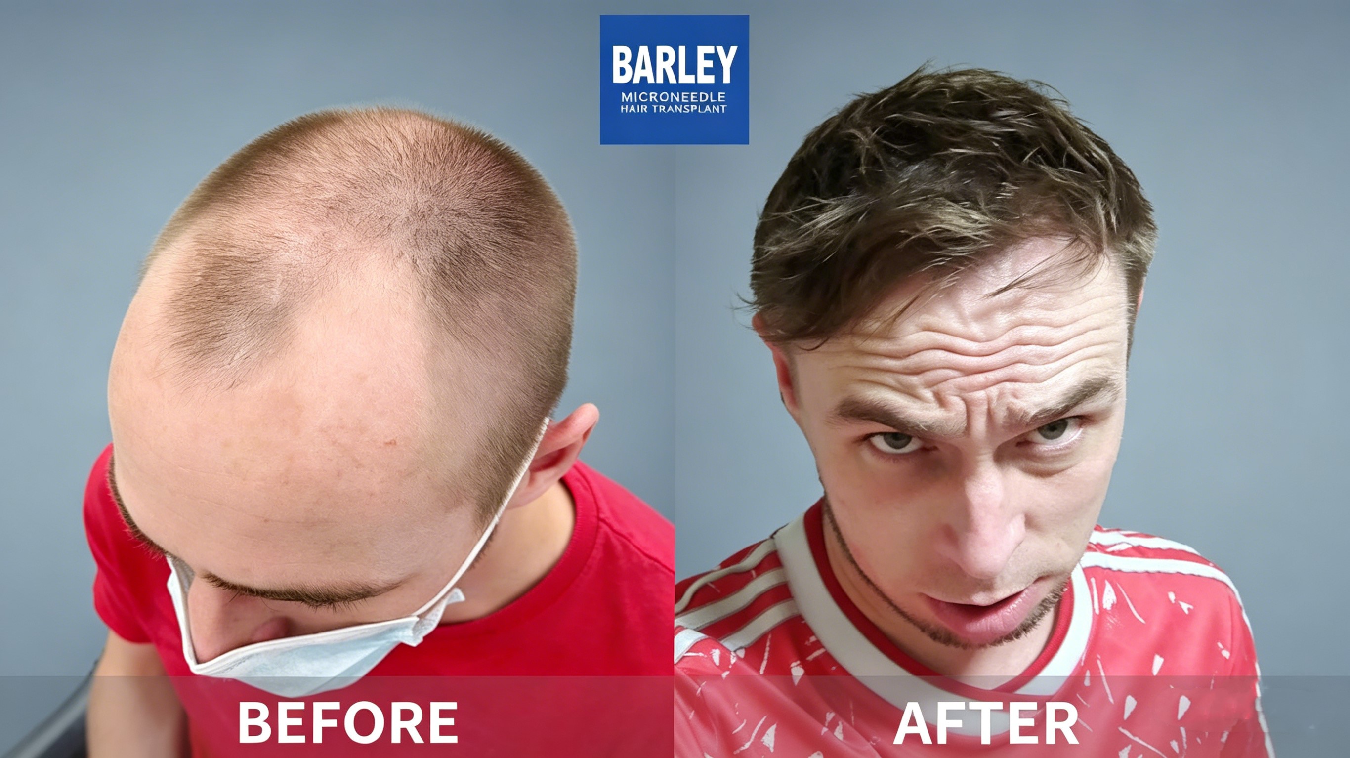 Cases - Professional Hair Transplant Service