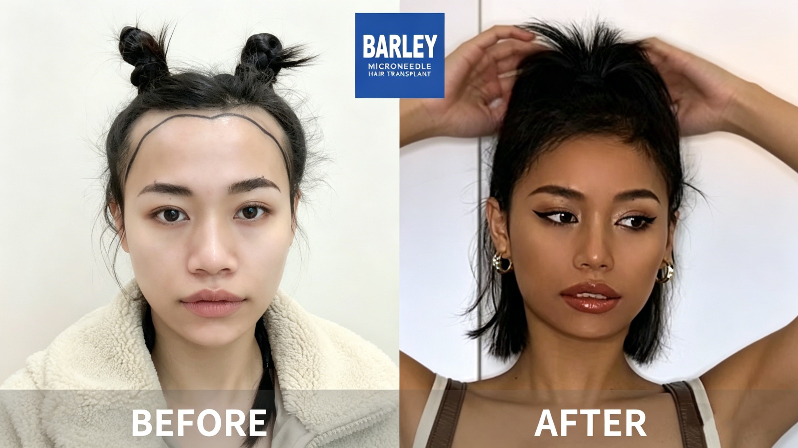 Baldness Restoration