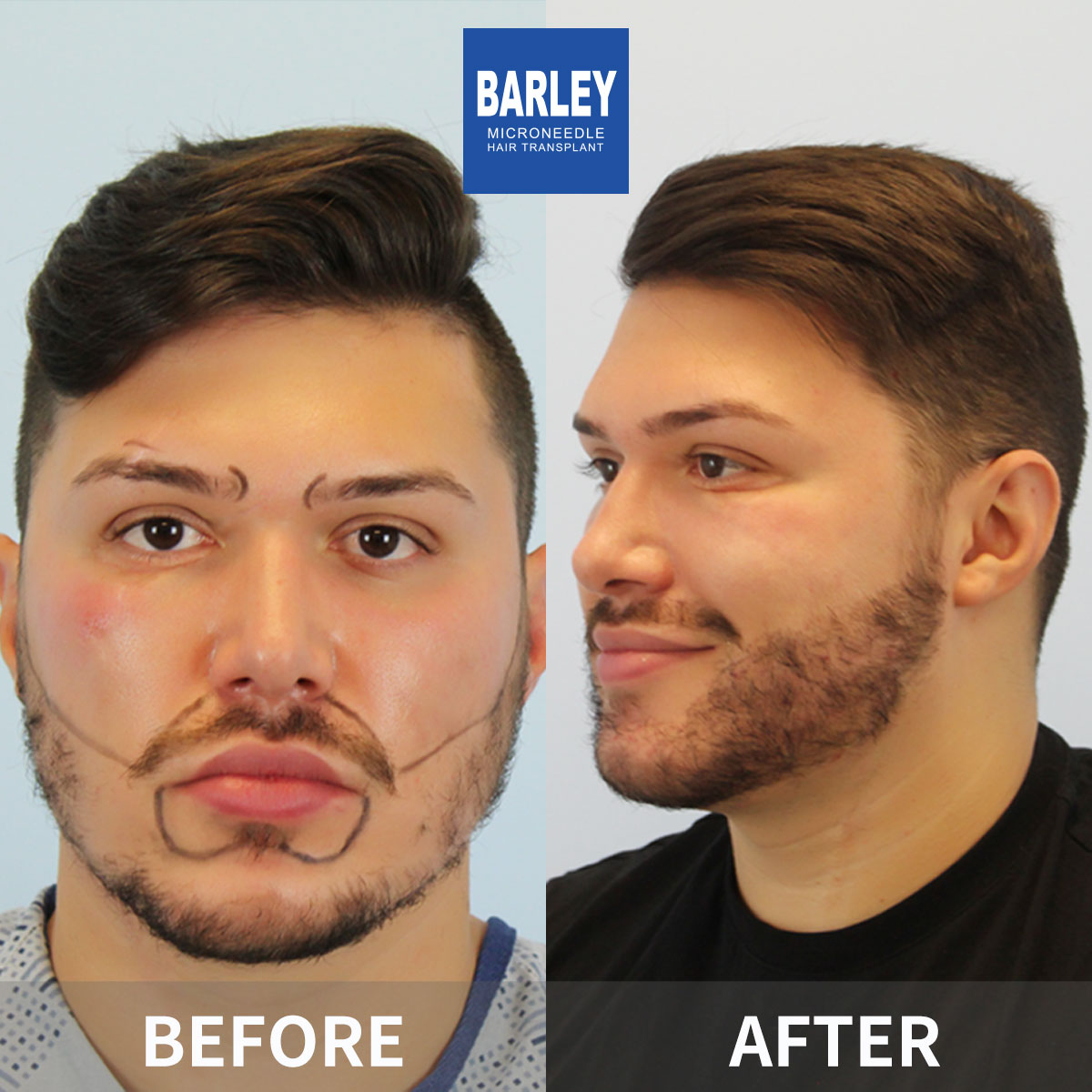 Beard Transplant Result
