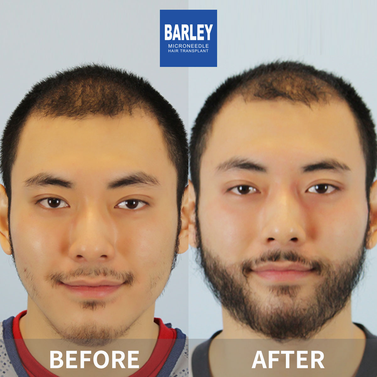 Beard Transplant Result
