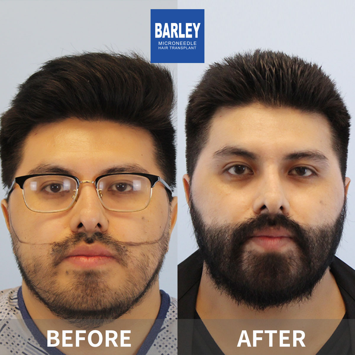 Beard Transplant Result