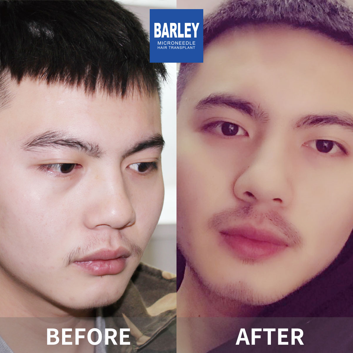 Beard Transplant Result