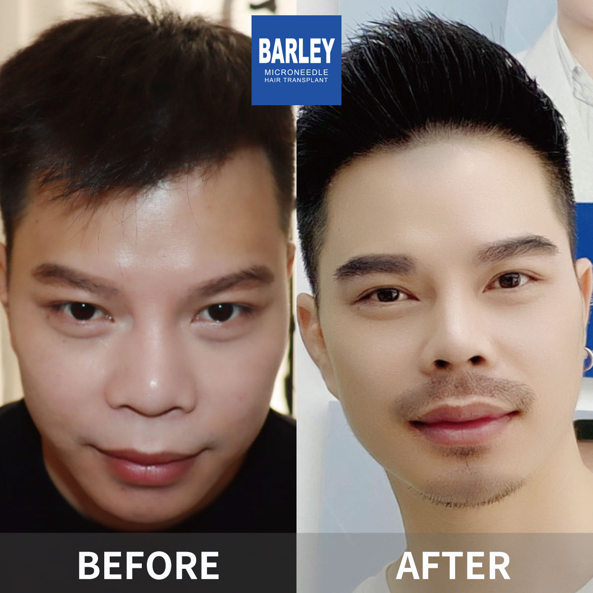 Beard Transplant Result