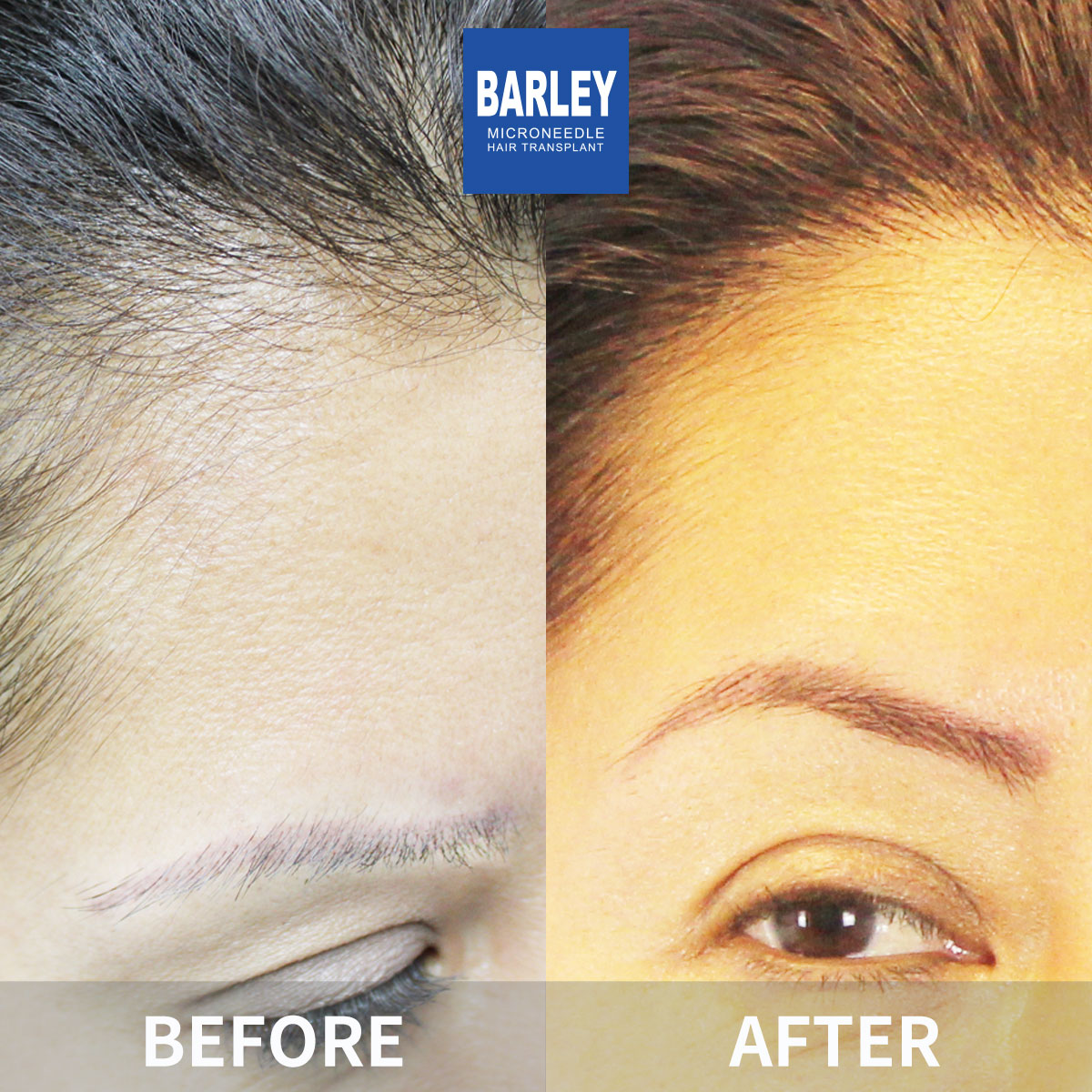 Eyebrow Transplant Result
