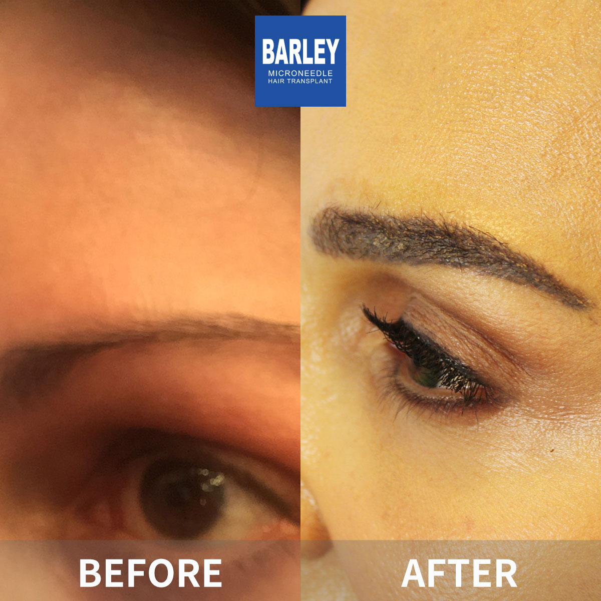 Eyebrow Transplant Result