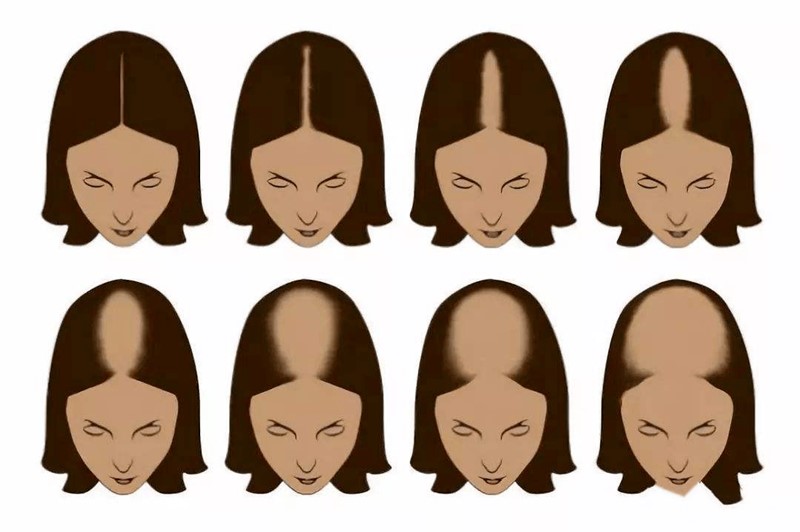 Ludwig Scale - Female Hair Loss Classification