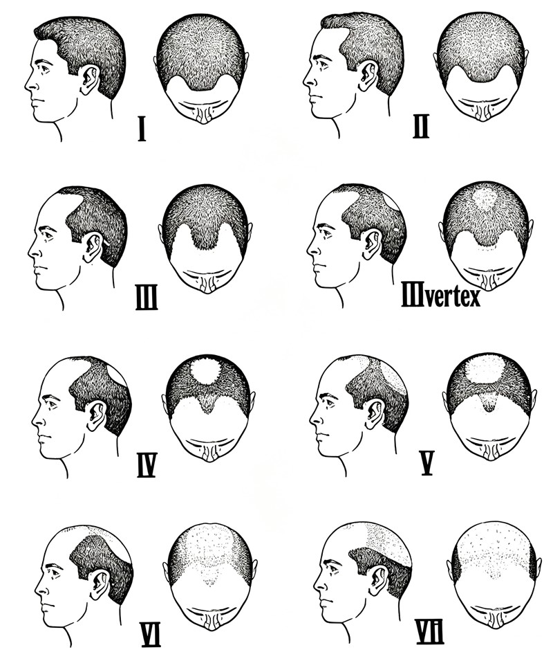 Hair Loss Norwood Scale