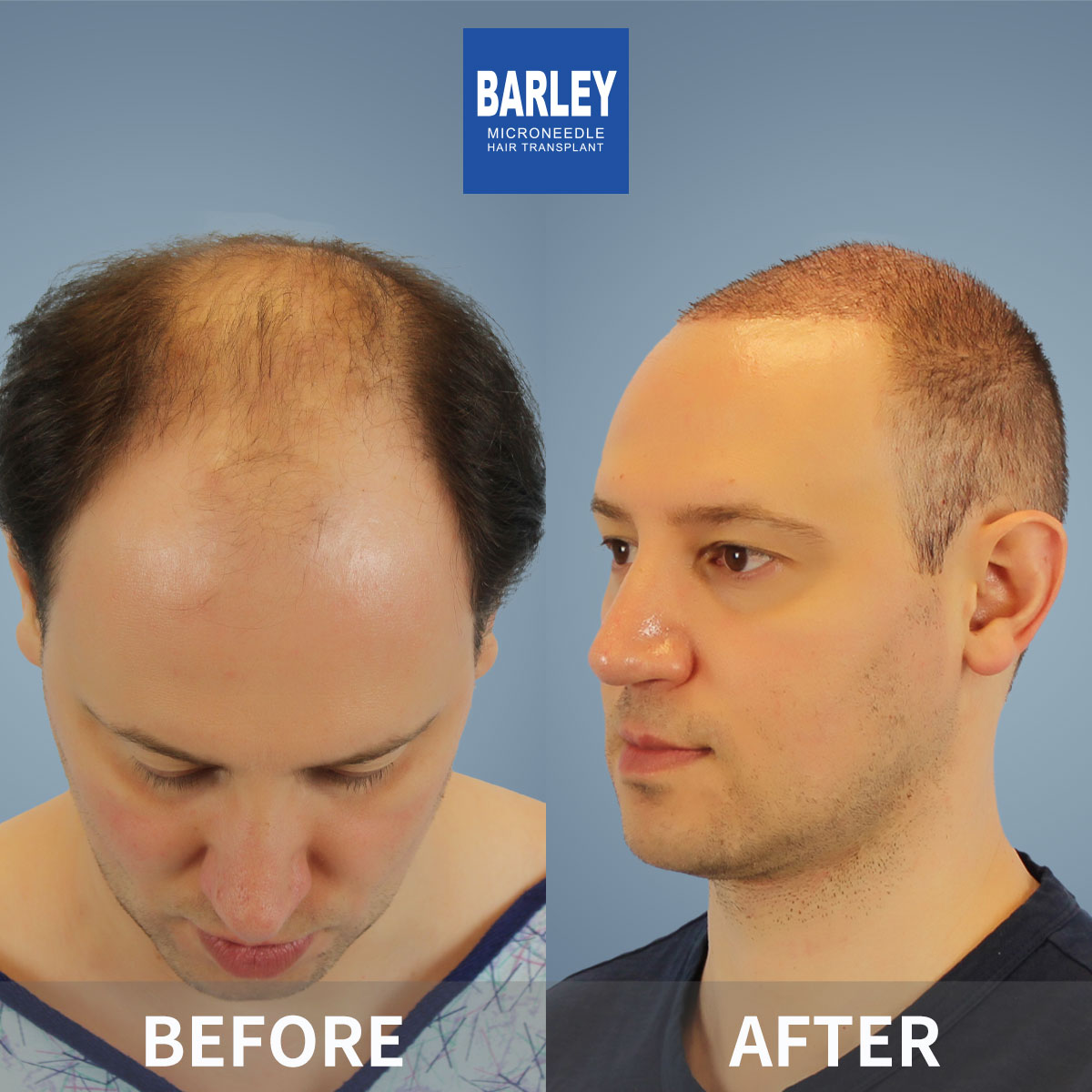 Baldness Restoration Result