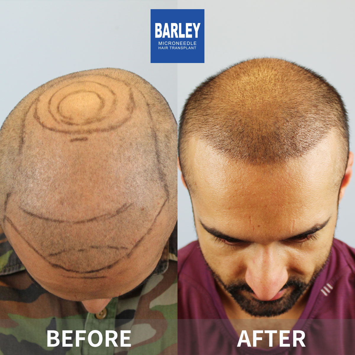 Baldness Restoration Result