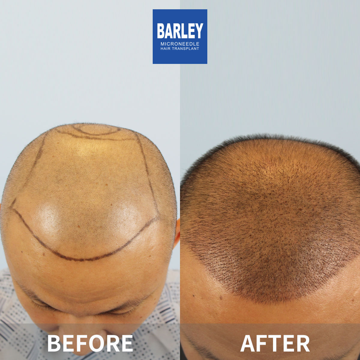 Baldness Restoration Result