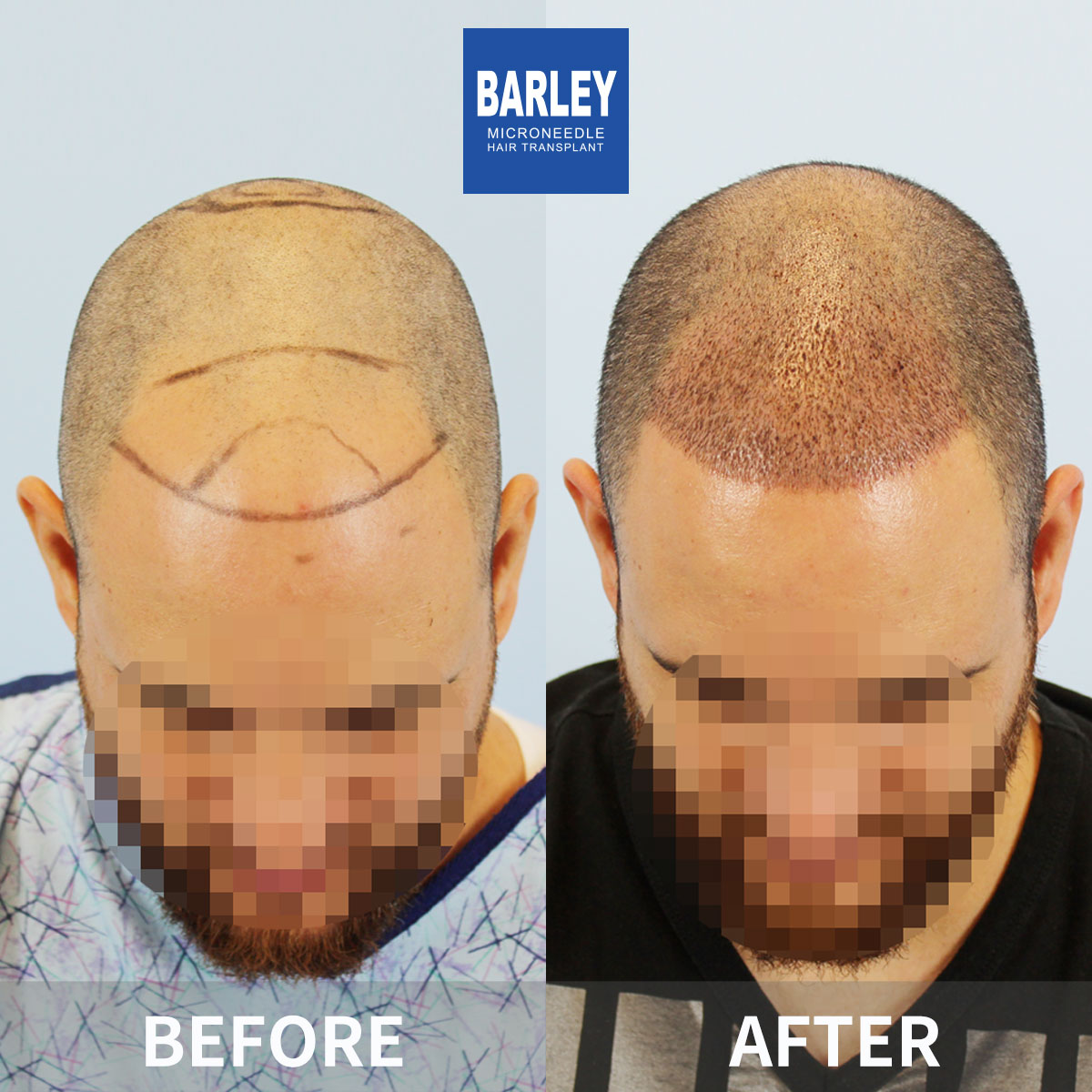 Male Baldness Treatment