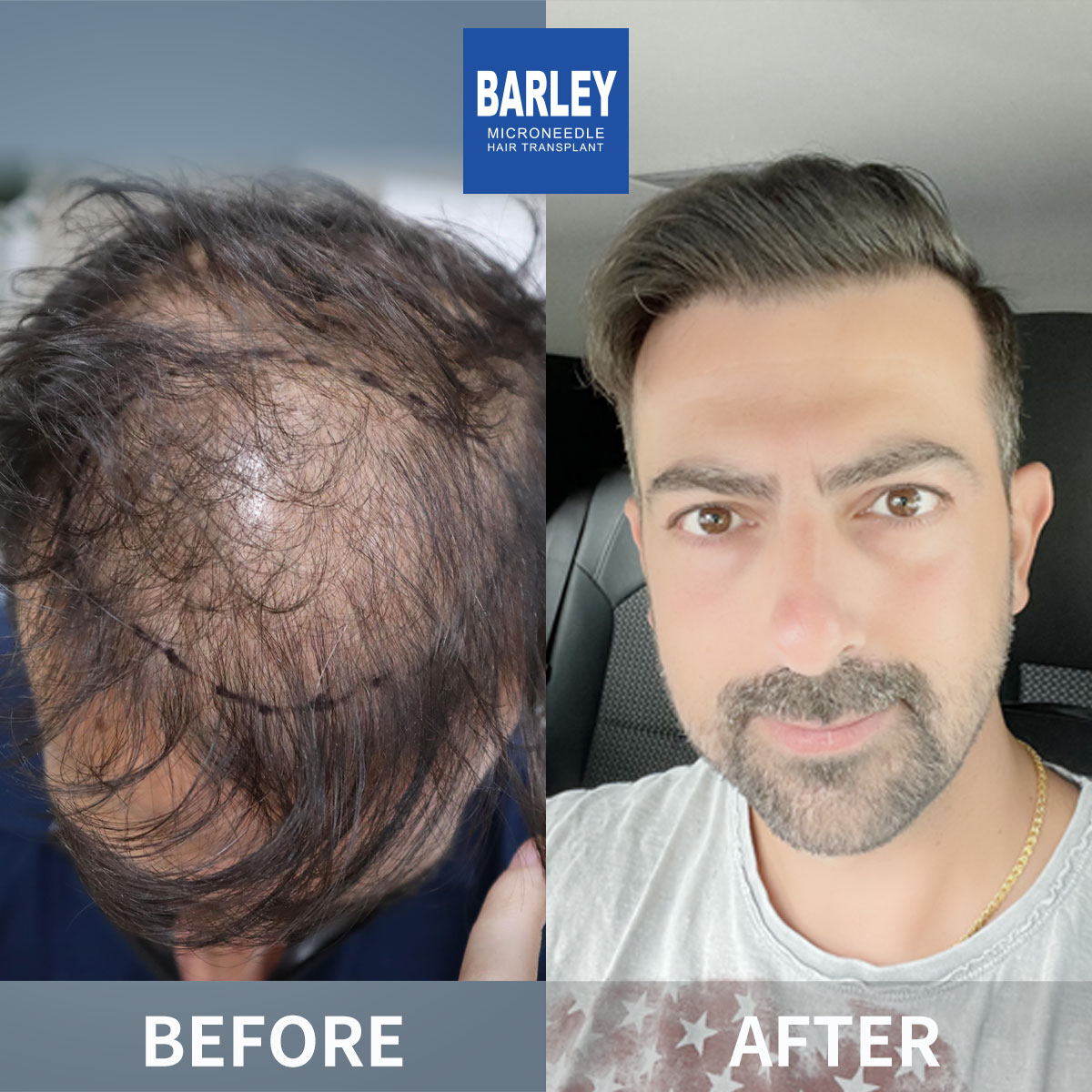 Baldness Restoration Result