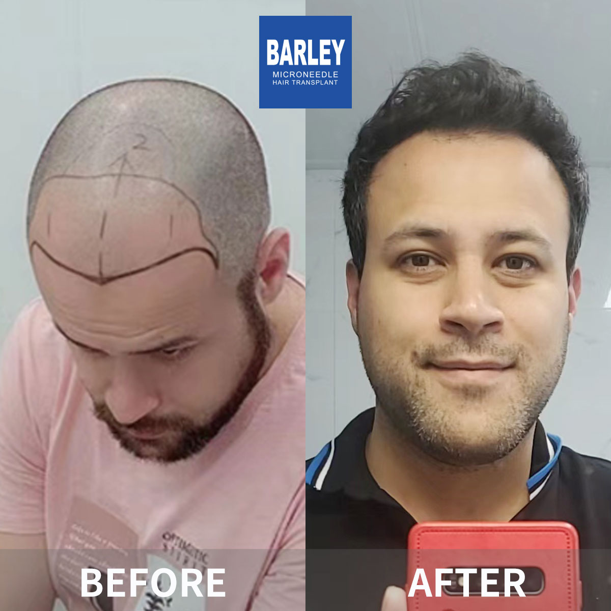 Baldness Restoration Result