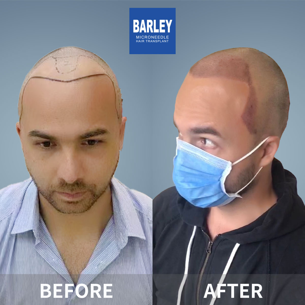 Baldness Restoration Result