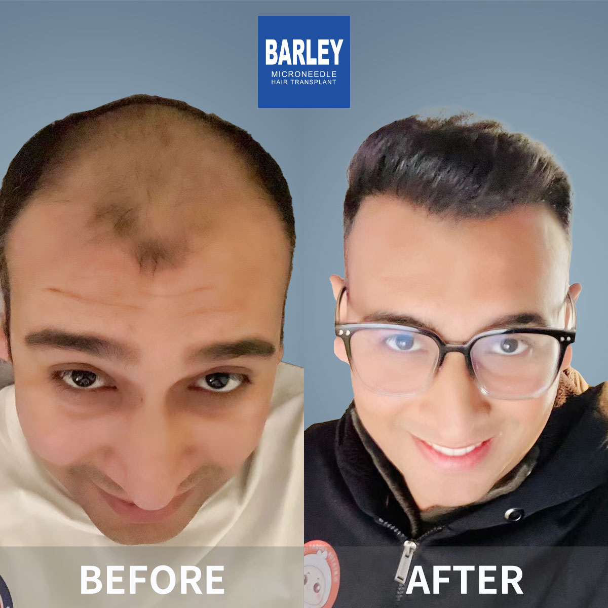 Baldness Restoration Result