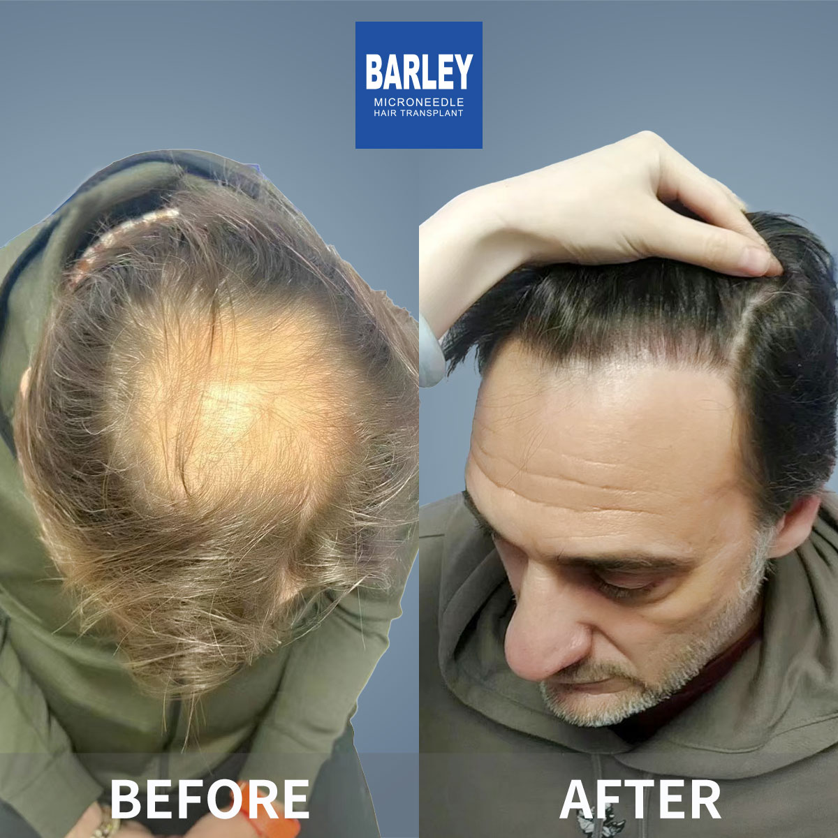 Baldness Restoration Result