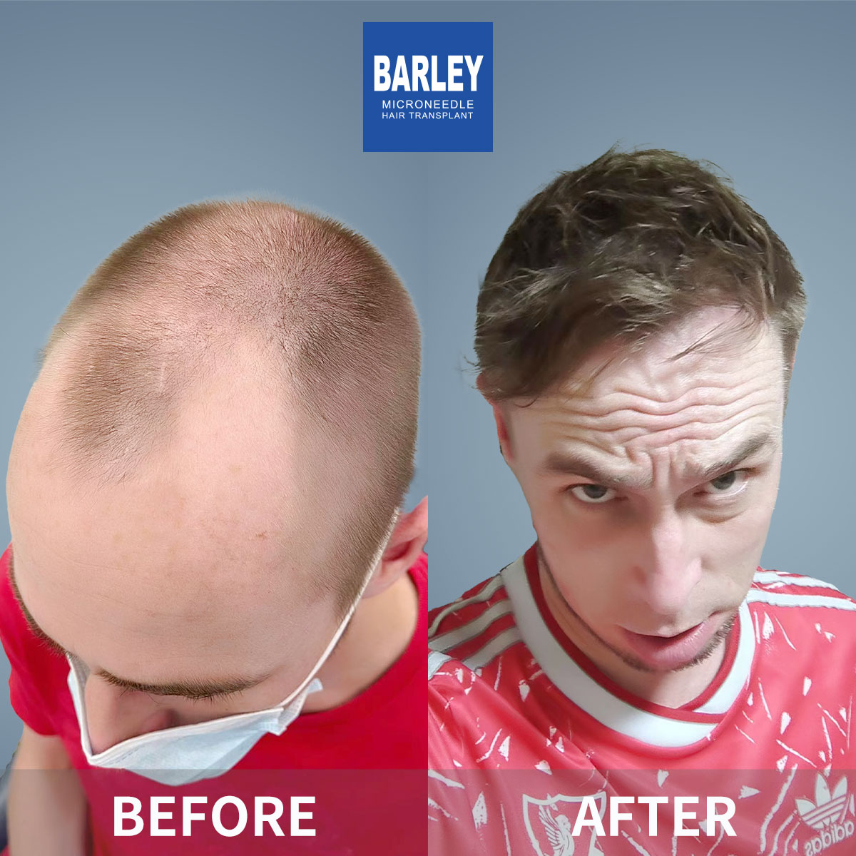 Vertex Hair Transplant