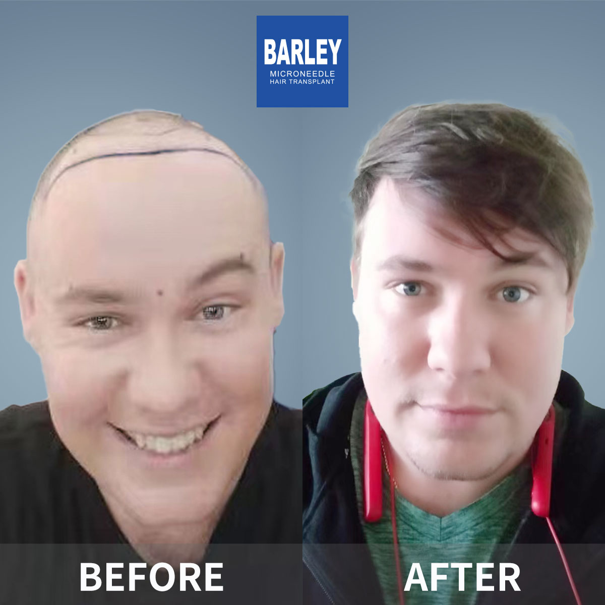 Baldness Restoration Result