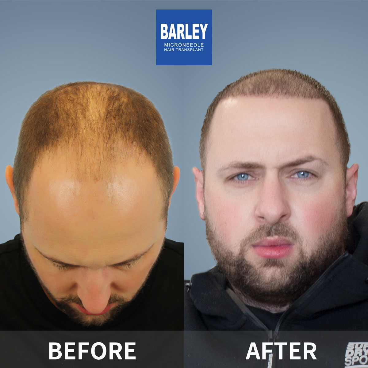 Baldness Restoration Result