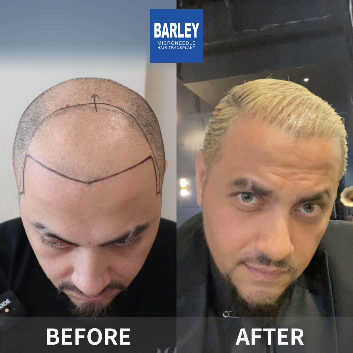 Baldness Restoration Result