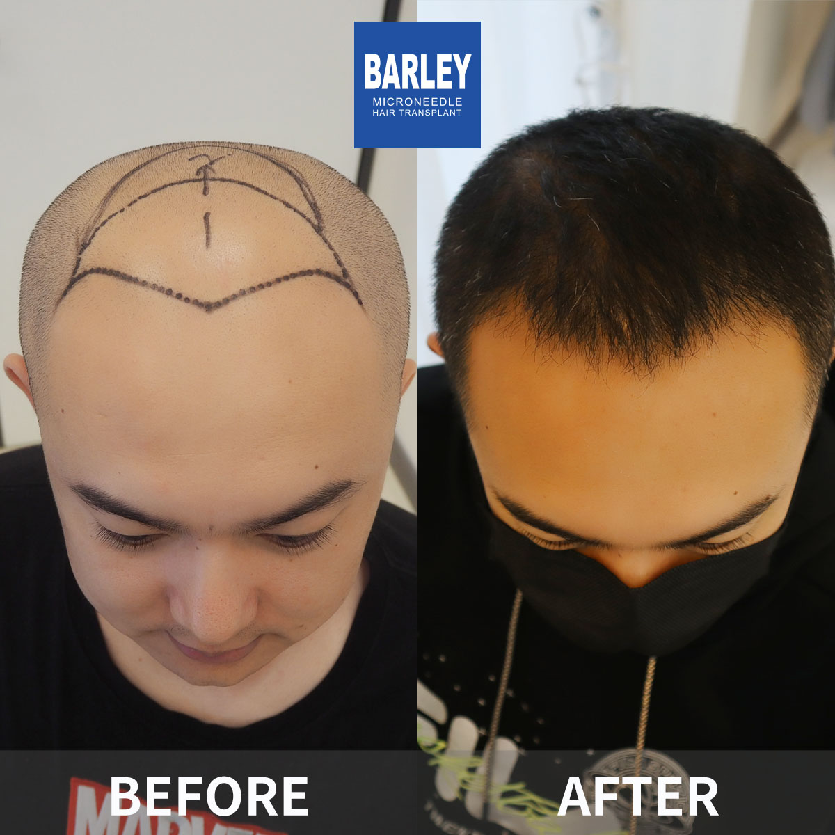 Baldness Restoration Result