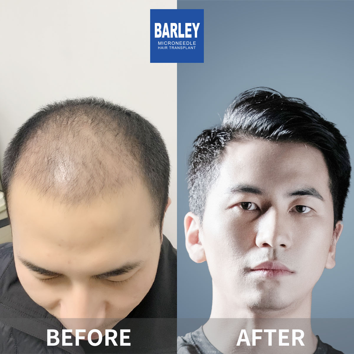 Baldness Restoration Result