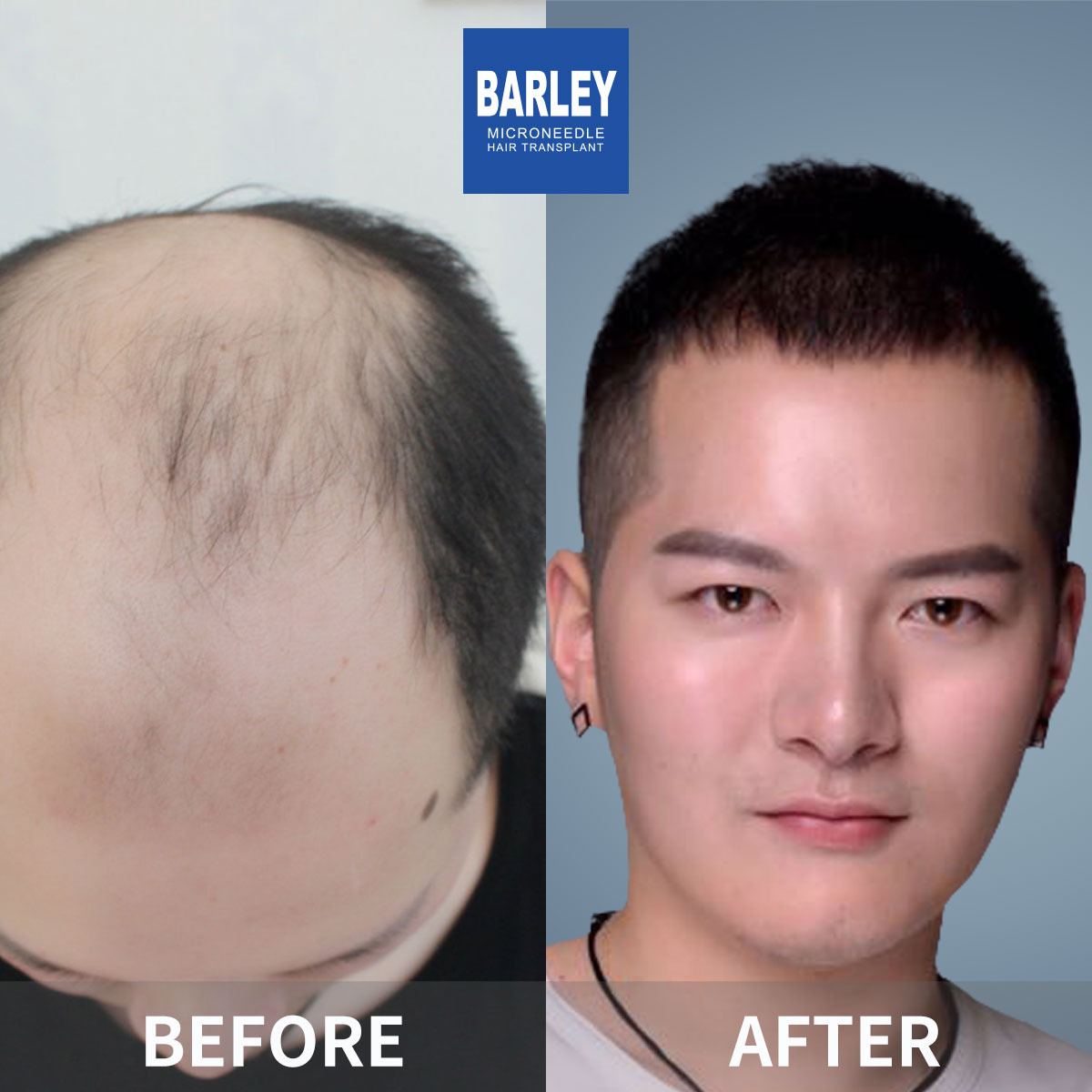 Baldness Restoration Result