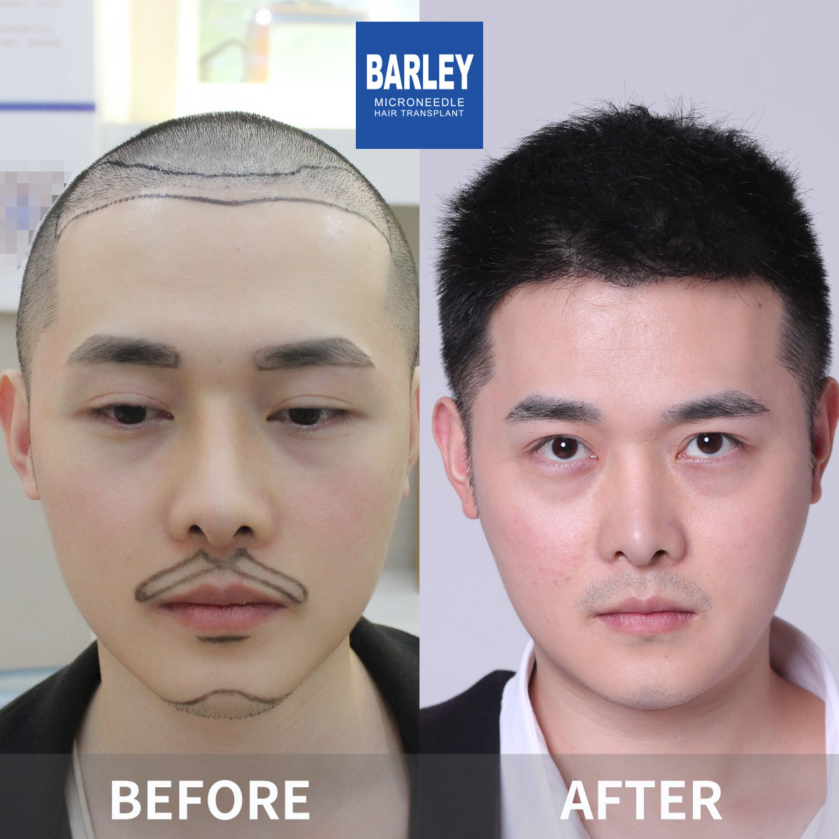 Baldness Restoration Result