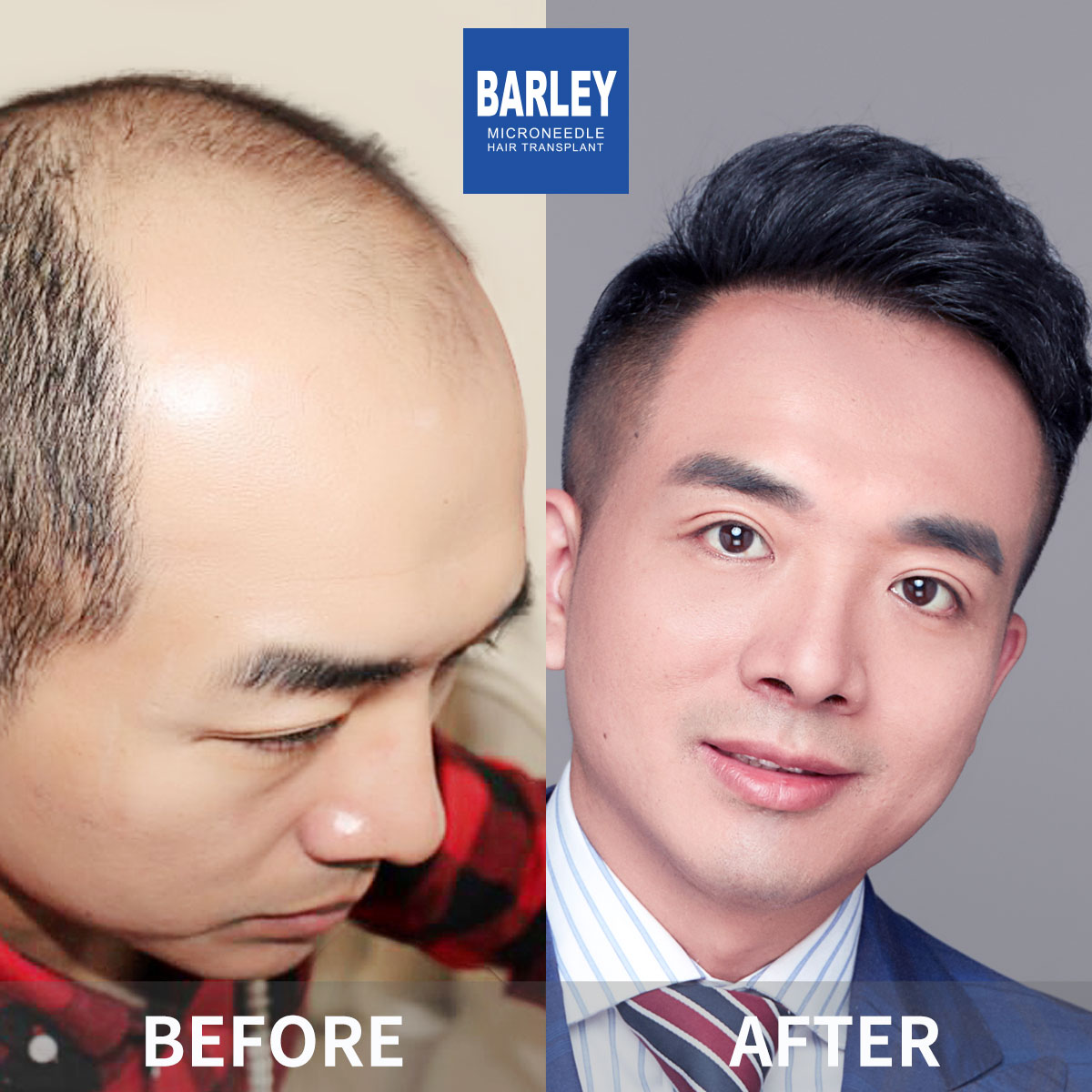Baldness Restoration Result
