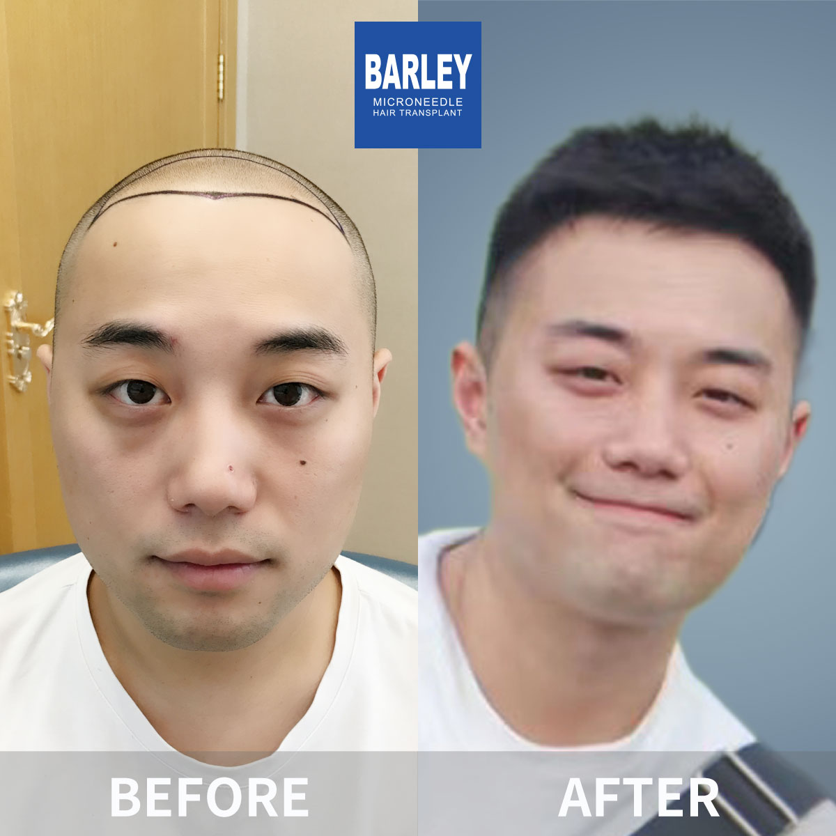 Baldness Restoration Result