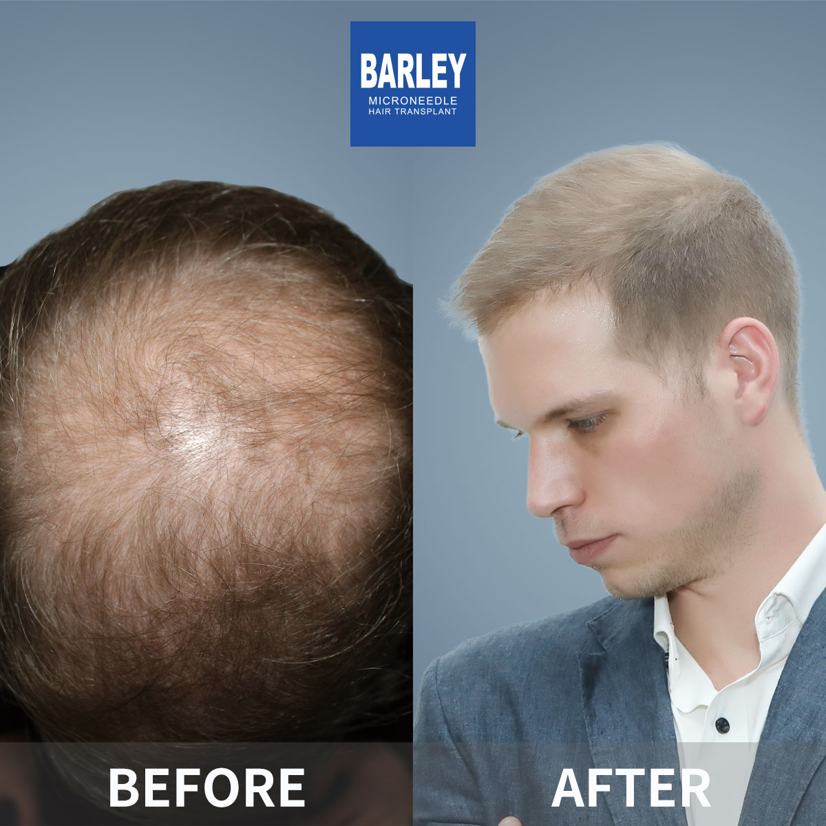 Baldness Restoration Result