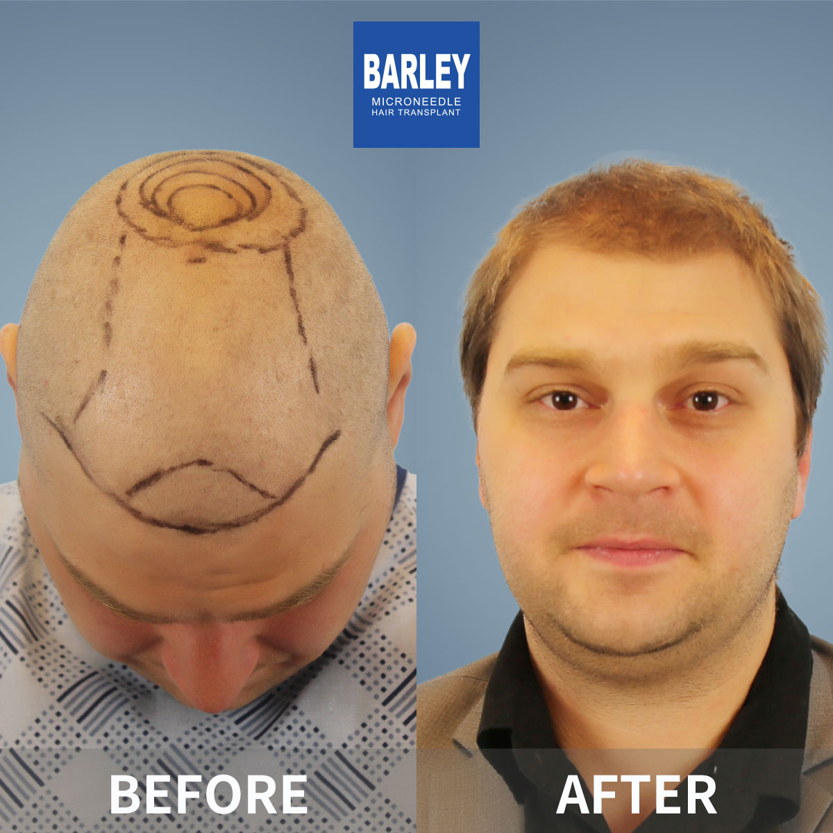 Baldness Restoration Result