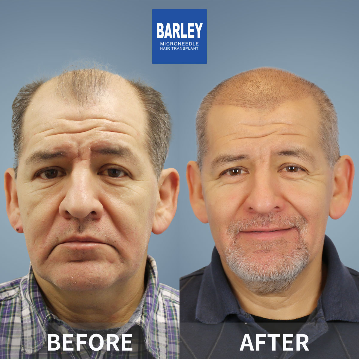 Baldness Restoration Result