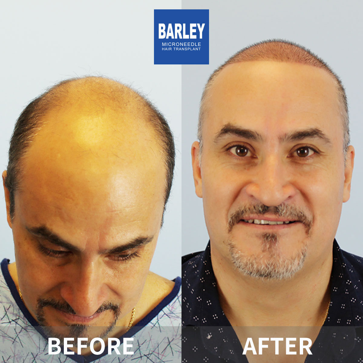 Baldness Restoration Result