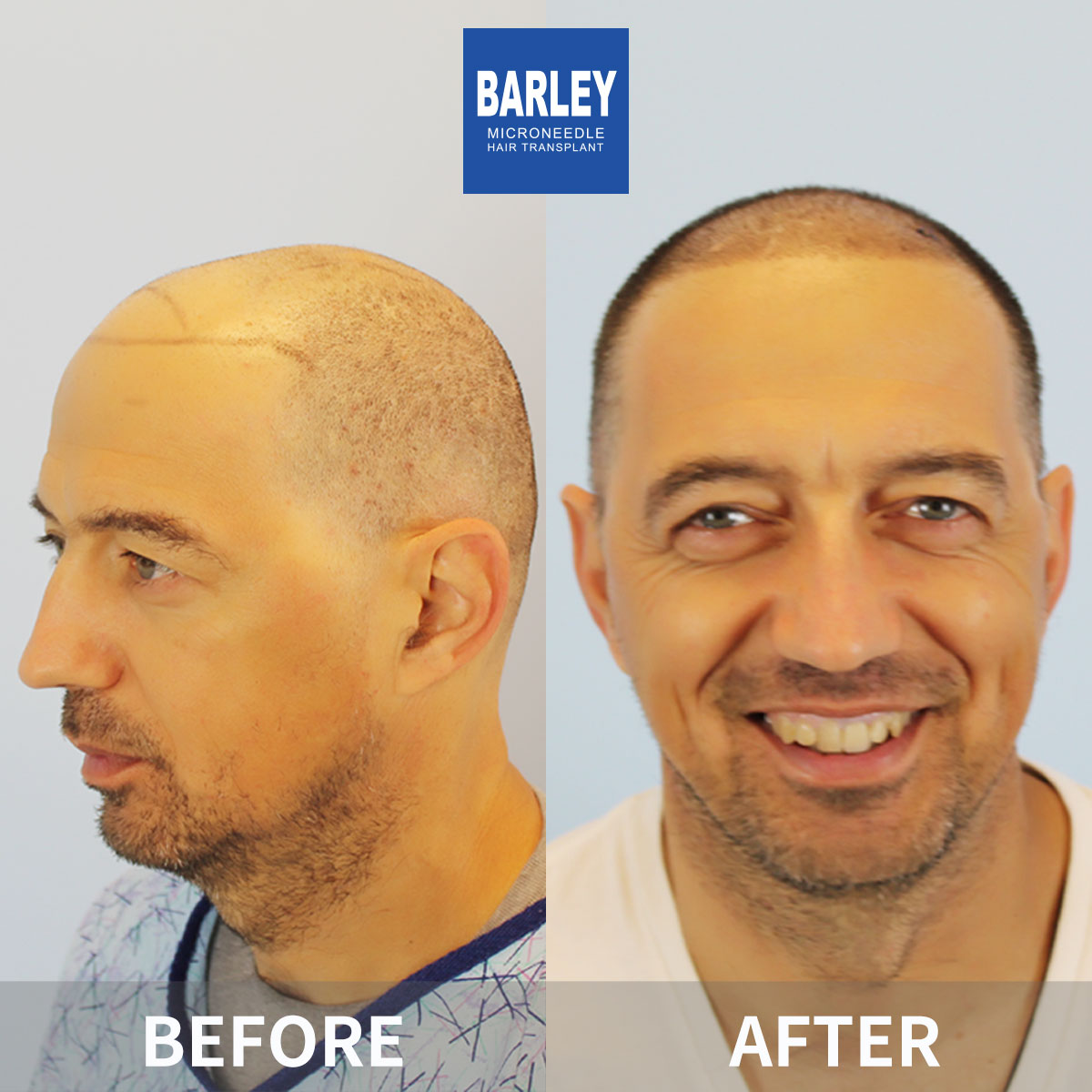 Baldness Restoration Result