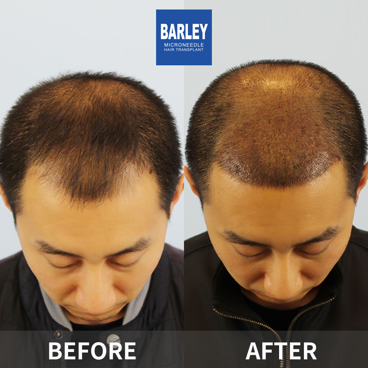 Baldness Restoration Result