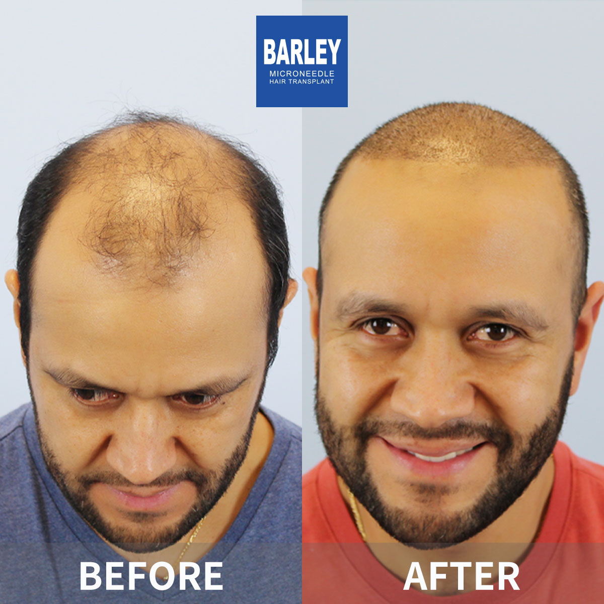 Baldness Restoration Result