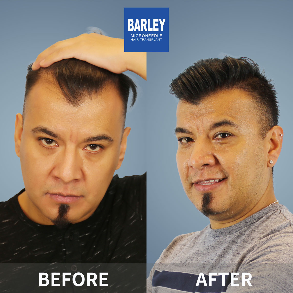 Hairline Transplant Result