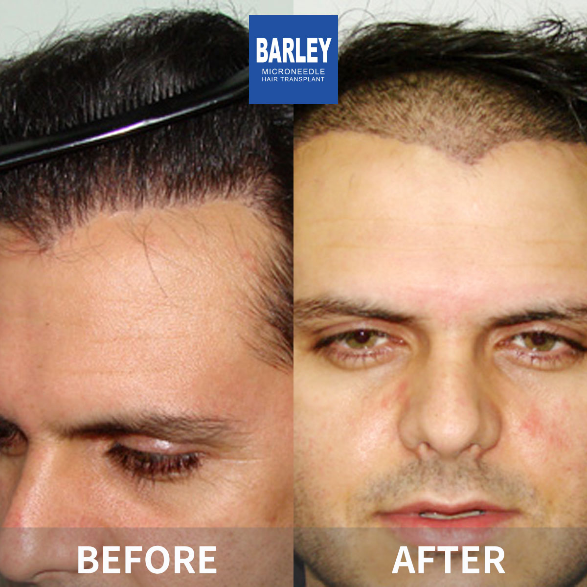 Hairline Transplant Result