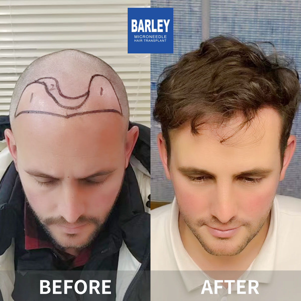 Hairline Transplant Result