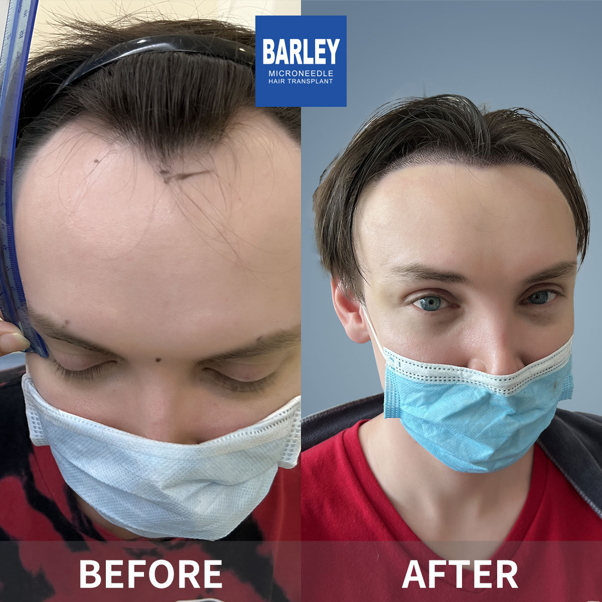 Hairline Transplant Result