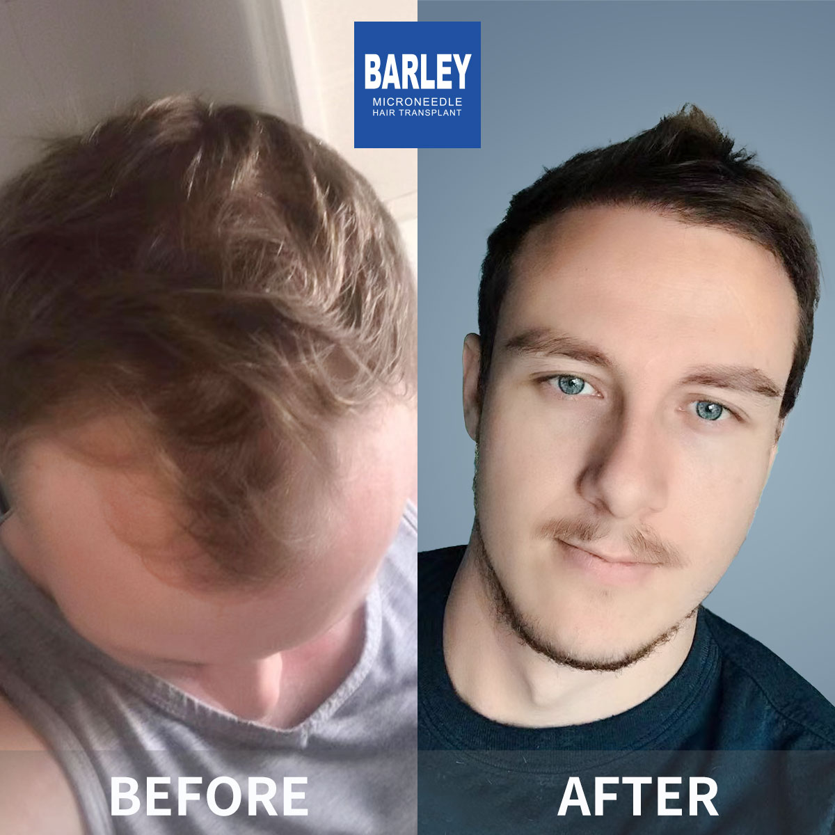 Hairline Transplant Result