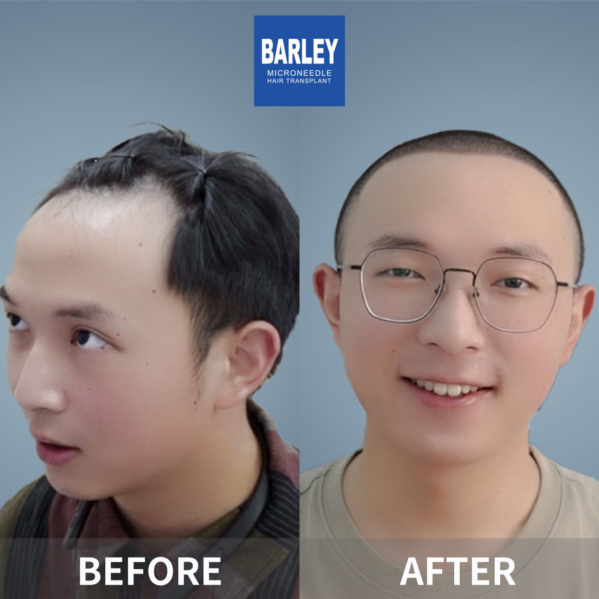 Male Hairline Transplant
