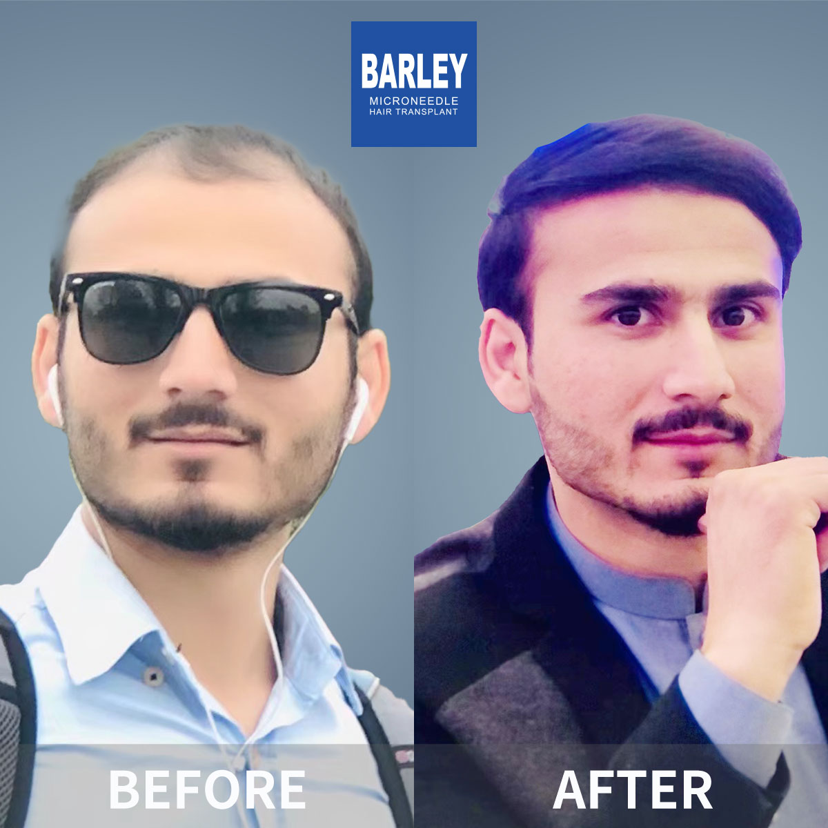 Hairline Transplant Result