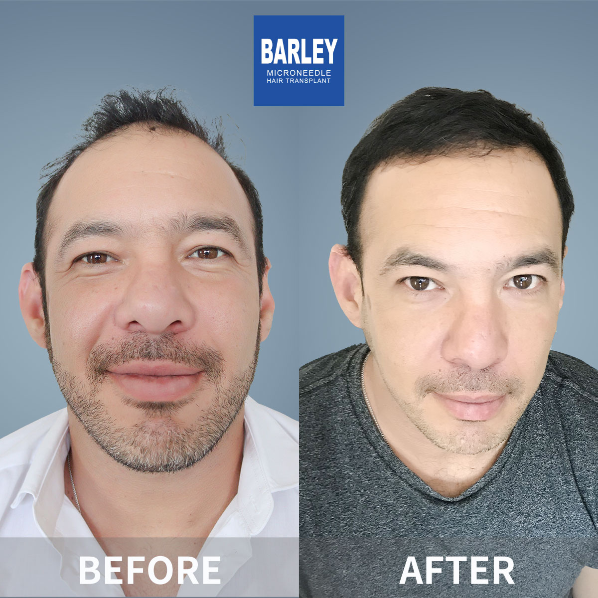 Hairline Transplant Result