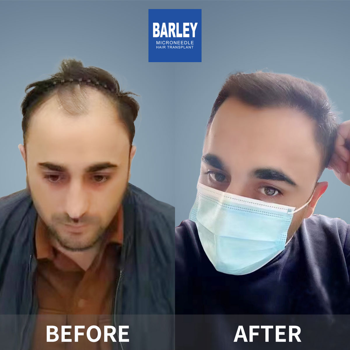 Hairline Transplant Result