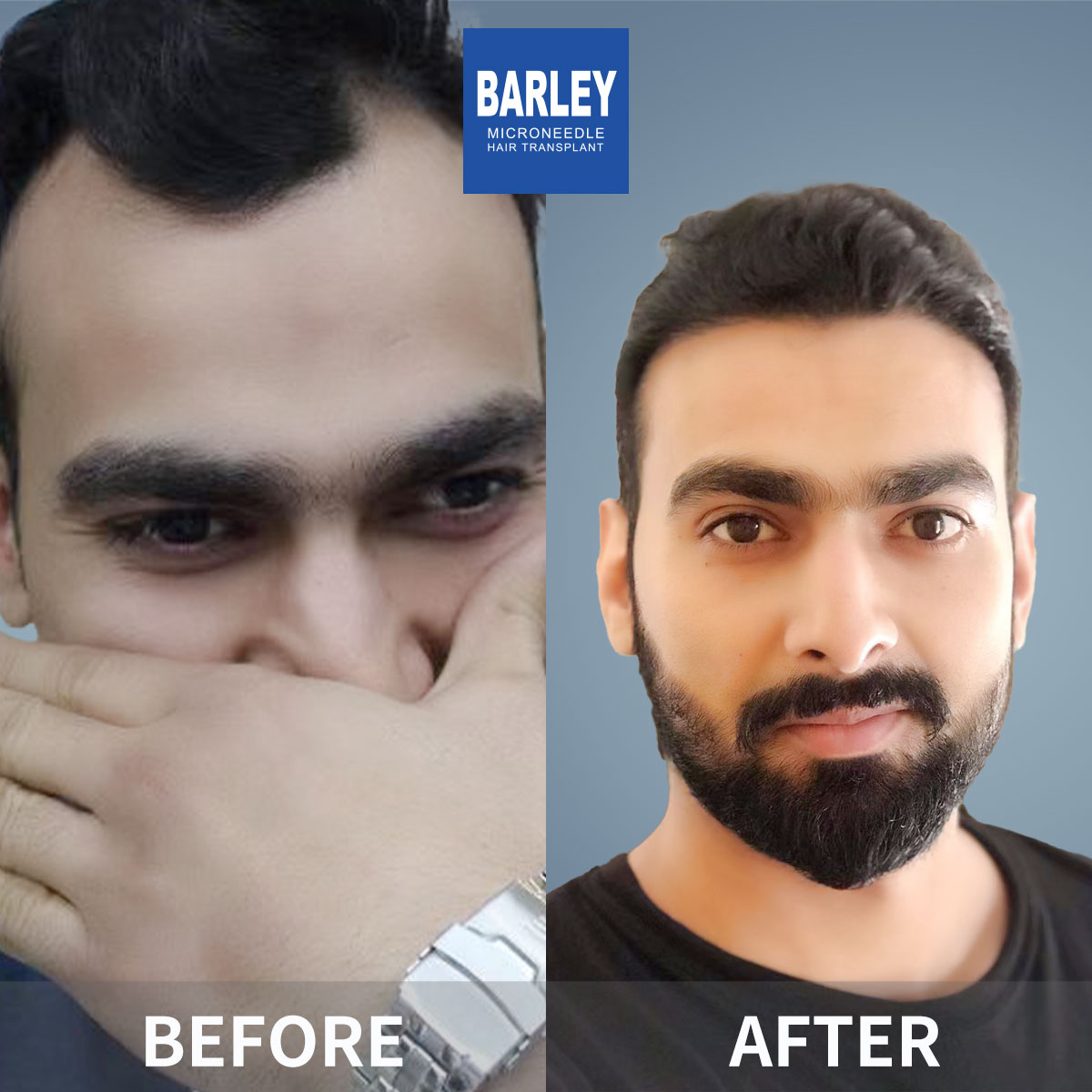 Hairline Transplant Result
