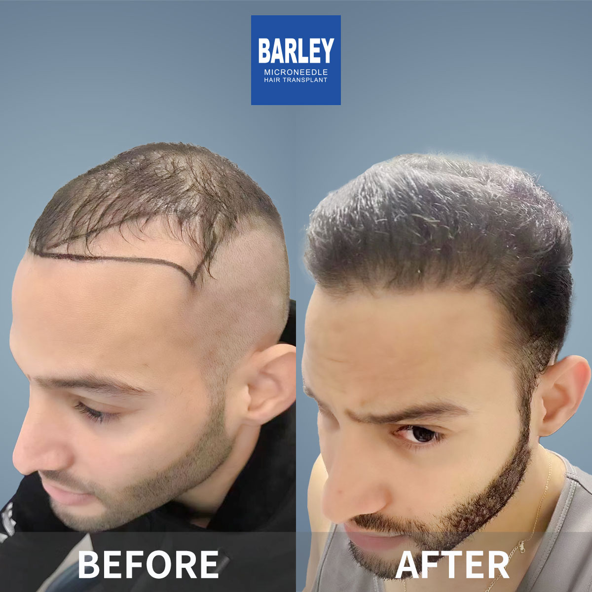 Hairline Transplant Result