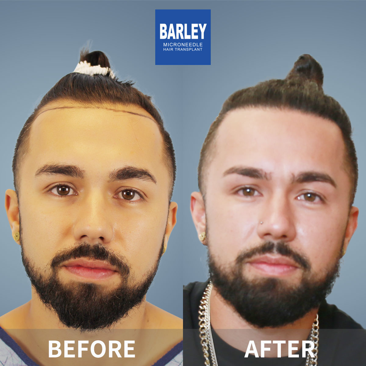 Hairline Transplant Result