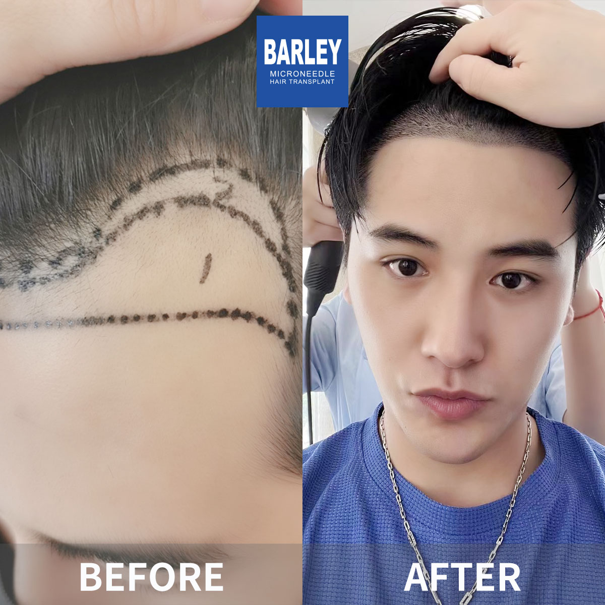 Hairline Transplant Result